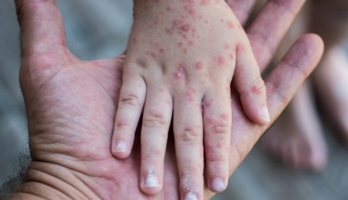 306 Kasus Campak, Pemkab Bima Tetapkan Status KLB